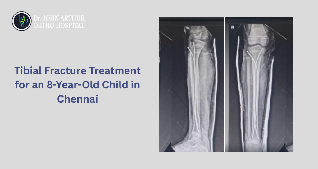 Tibial Fracture in an 8-Year-Old Child Treated with Titanium Elastic Nail System