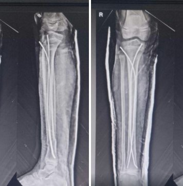 Tibial Fracture Treatment in CHennai